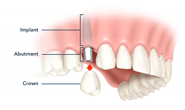 3 Components of Dental Implants